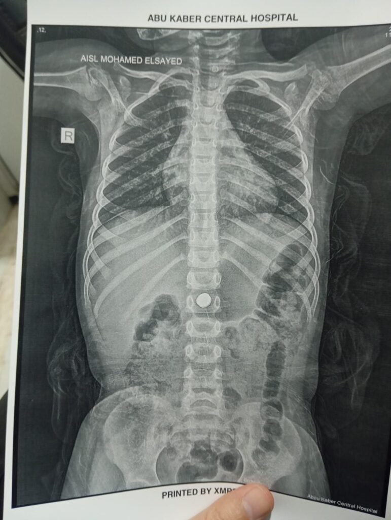 img-20260426-wa00572659957733184830458-771x1024 وكيل وزارة الصحة بالشرقية : استخراج بطارية من معدة طفلة ٤ سنوات  بمستشفى أبو كبير المركزي