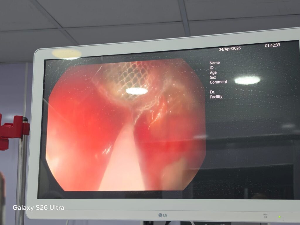 img-20260426-wa00582728292844411919235-1024x768 وكيل وزارة الصحة بالشرقية : استخراج بطارية من معدة طفلة ٤ سنوات  بمستشفى أبو كبير المركزي