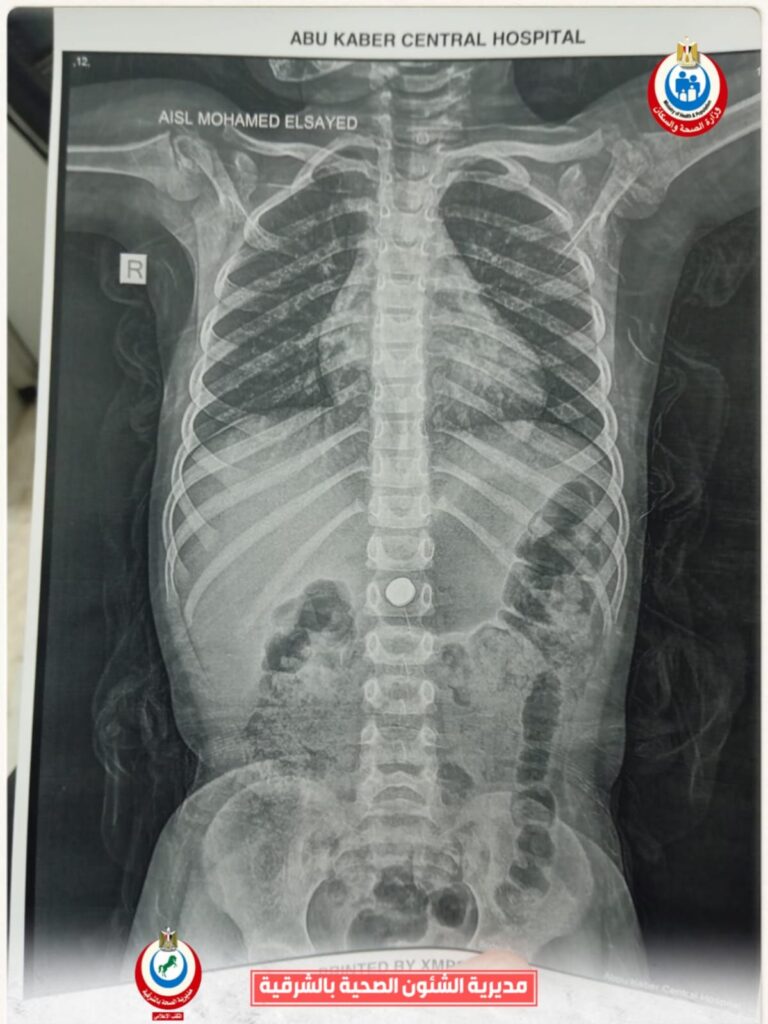 img-20260426-wa00592247226751966305727-768x1024 وكيل وزارة الصحة بالشرقية : استخراج بطارية من معدة طفلة ٤ سنوات  بمستشفى أبو كبير المركزي